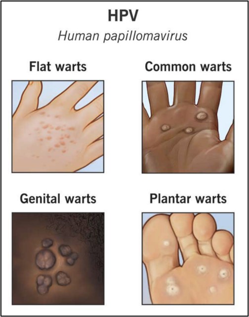 HPV Warts