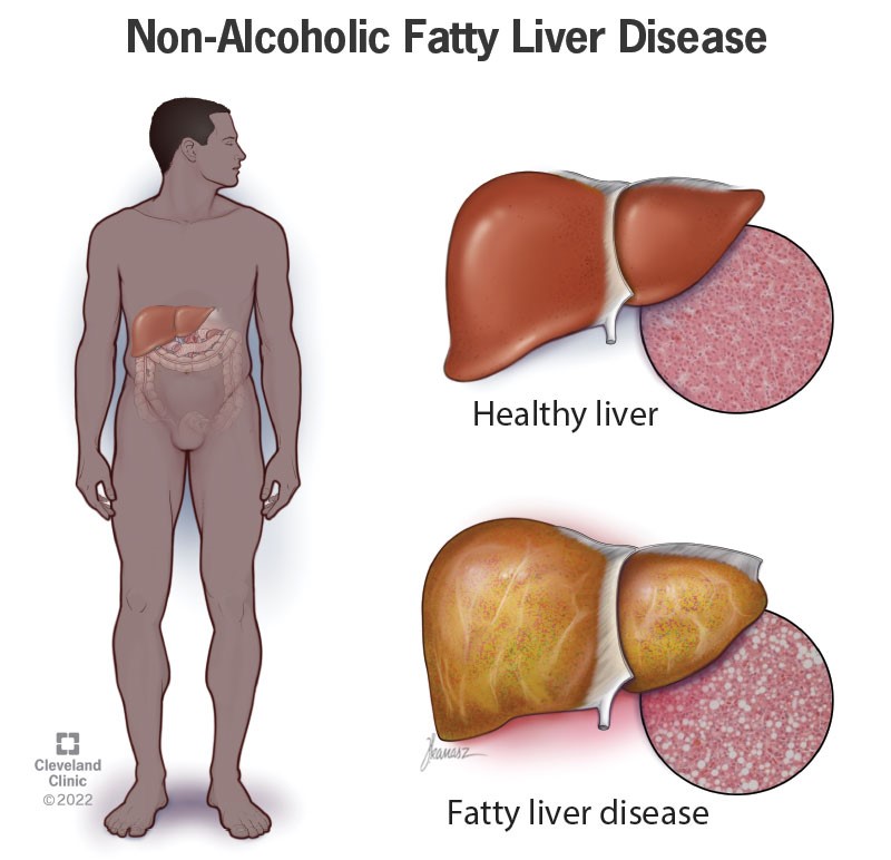 NAFLD