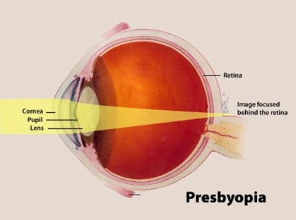 Presbyopia